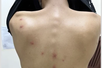 Tính đến nay, Thành phố Hồ Chí Minh đã ghi nhận 4 ca bệnh đậu mùa khỉ trong tổng số 5 trường hợp của cả nước.