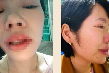 Cô giáo Vũ Thị Kim Q bị phụ huynh học sinh đến tận nhà riêng hành hung.