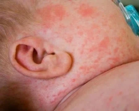 [Video] Hà Nội ghi nhận thêm 189 ca mắc sởi trong một tuần