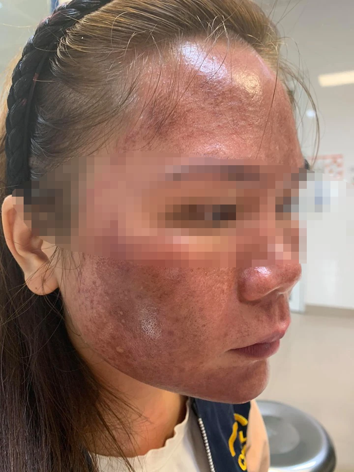 Bỏng da mặt vì hóa chất từ thuốc lột da trôi nổi -0