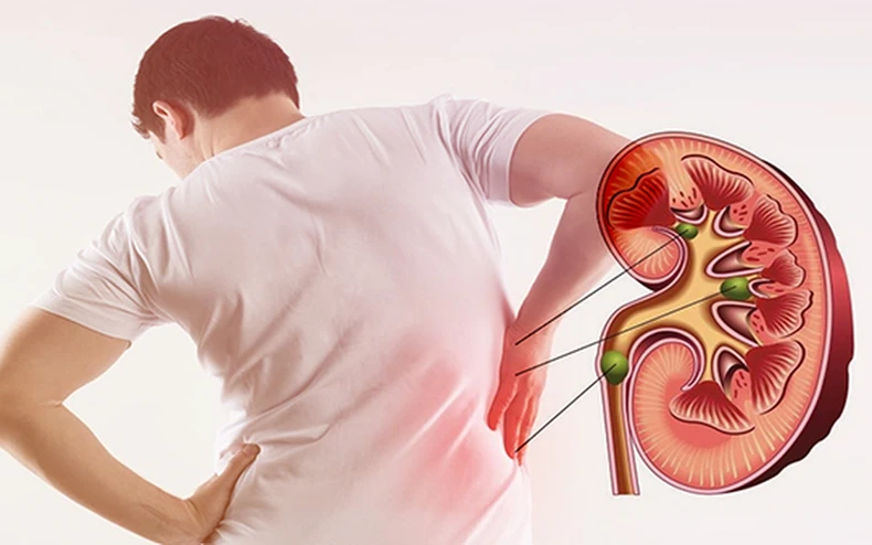 Đừng để hỏng thận chỉ vì chủ quan tự điều trị thuốc nam -0