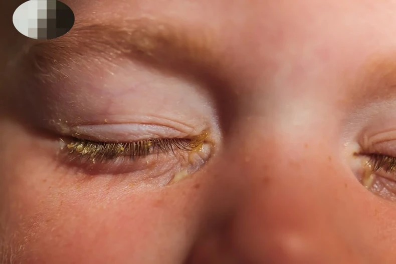 Đau mắt đỏ ở trẻ em: Khi nào cần đưa trẻ đi khám? ảnh 1