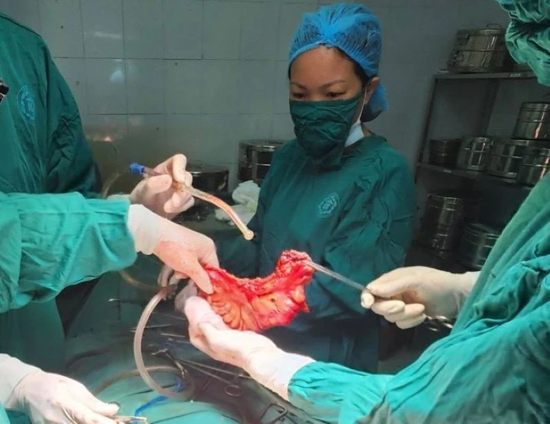 Bệnh viện tuyến huyện ở Thái Bình phẫu thuật thành công ca cắt đại tràng cho bệnh nhân K ảnh 1