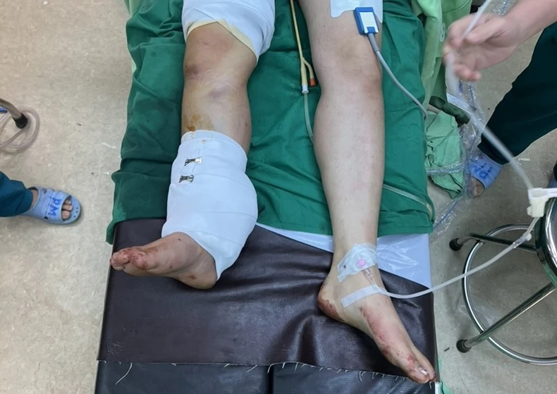 Phẫu thuật nối liền bàn chân bị đứt rời cho bệnh nhân bị tai nạn giao thông ở Đắk Lắk ảnh 1