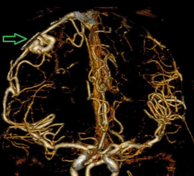 Người trẻ không chủ quan với những dấu hiệu của bệnh dị dạng mạch máu não ảnh 1