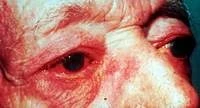 Hình ảnh mắt tổn thương do zona virut.