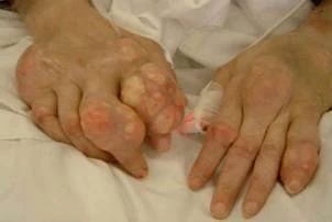 Gout khiến bệnh nhân rất đau đớn và bị biến dạng khớp, có thể dẫn đến tàn tật.