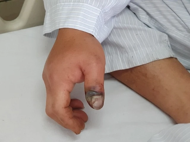Hình ảnh vết rắn cắn ở ngón cái bàn tay phải bị sưng đỏ, có dấu hiệu hoại tử.
