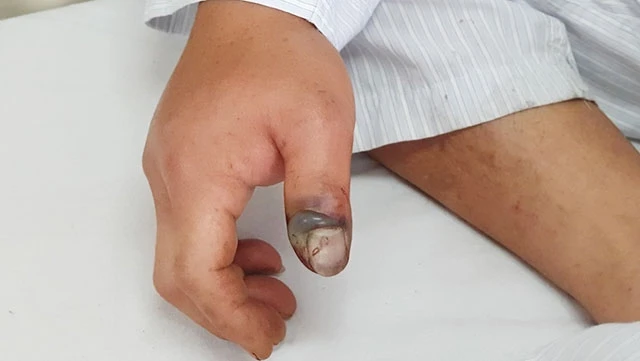Hình ảnh vết rắn cắn ở ngón cái bàn tay phải bị sưng đỏ, có dấu hiệu hoại tử. Ảnh: suckhoedoisong.vn
