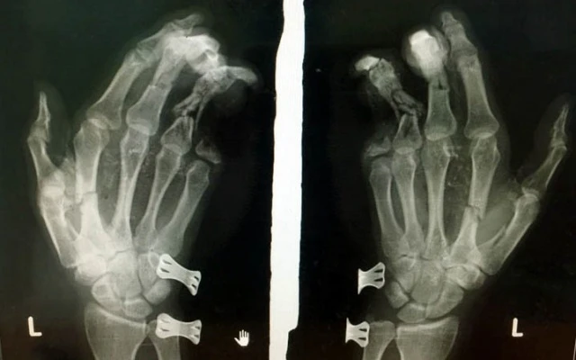 Phim chụp bàn tay của bệnh nhân bị tổn thương do điện thoại phát nổ.