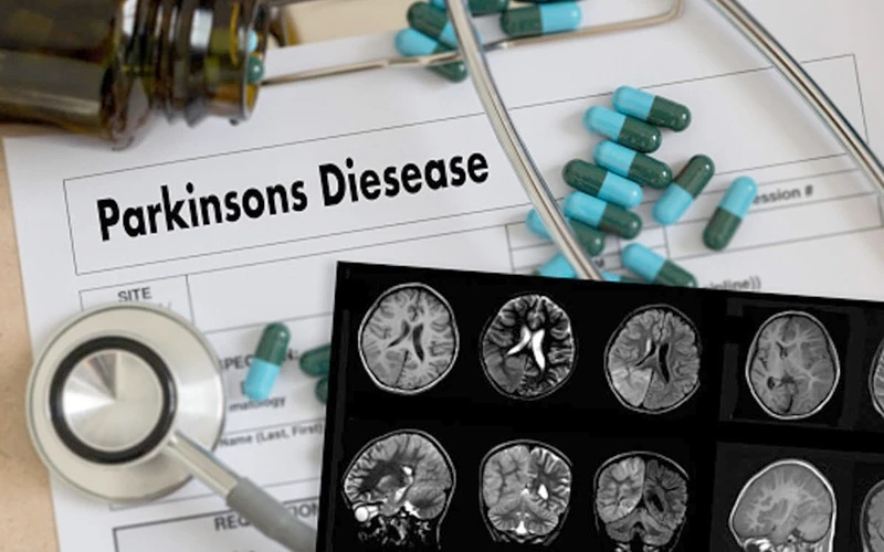 AI có thể giúp theo dõi chính xác từ xa bệnh nhân mắc Parkinson.