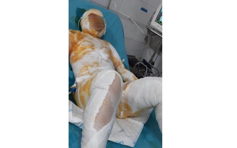 Chị Nguyễn Thị Hương bị bỏng 77% cơ thể do chồng tẩm xăng đốt, ngày 23-8.