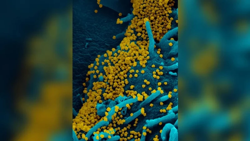 Hình ảnh hiển vi điện tử quét virus SARS-CoV-2 thu được từ một phụ nữ mắc Covid-19 phát tán virus liên tục trong 70 ngày. Ảnh: NIAID-RML.
