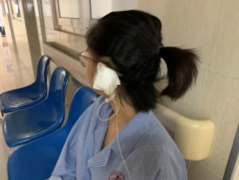 Bệnh nhân bị áp xe vành tai sau khi bấm khuyên vành tai. 