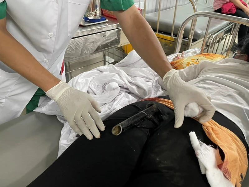 Nữ bệnh nhân N.T.Y.N. nhập viện cấp cứu với chân chống xe máy đâm dính vào mông.