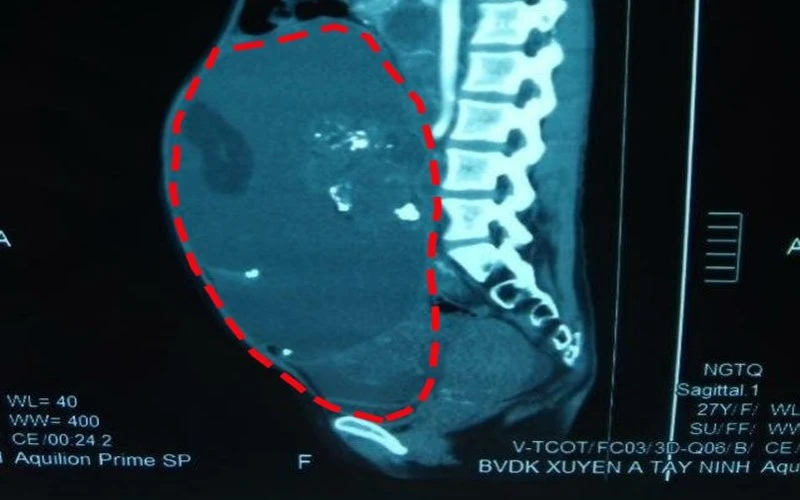 Hình ảnh khối u trước khi được bóc tách qua soi chụp. (Ảnh: Bệnh viện Xuyên Á)