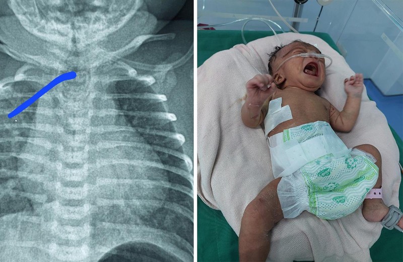 Kon Tum: Phẫu thuật thành công bệnh teo thực quản bẩm sinh cho trẻ 3 ngày tuổi