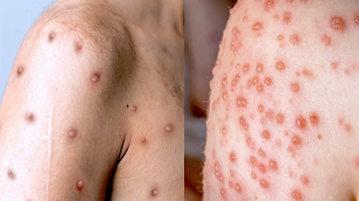 Một số biểu hiện thương tổn da là những mụn mủ, bóng mủ đa kích thước… của bệnh Đậu mùa khỉ (ảnh Báo Phụ nữ).