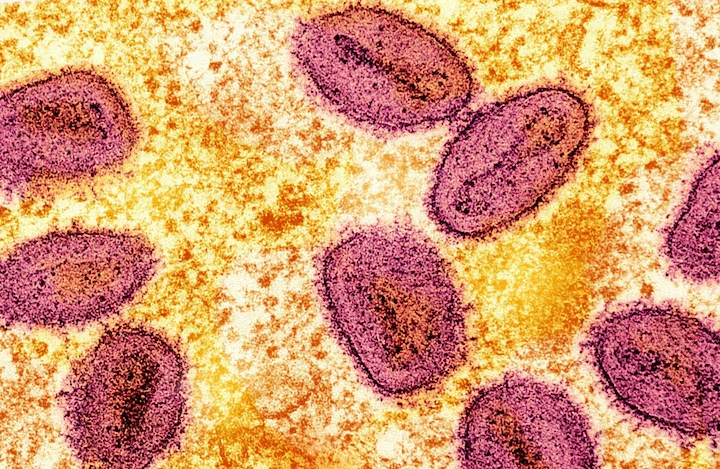 Virus đậu mùa khỉ (màu hồng) dưới kính hiển vi. Ảnh: Reuters.