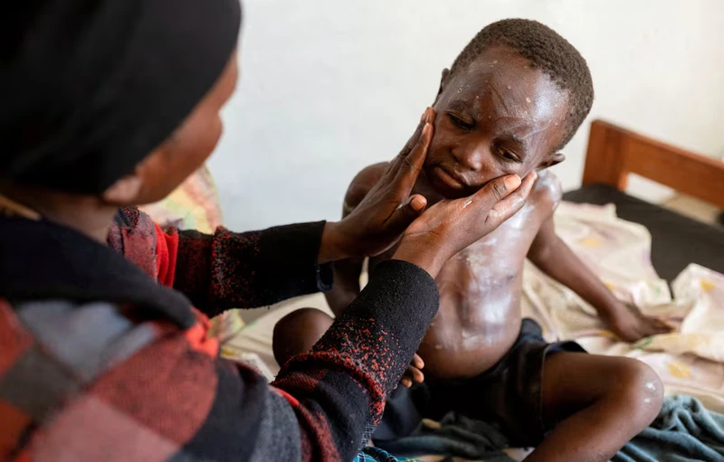 Một bệnh nhân đậu mùa khỉ đang được bôi thuốc lên da. Ảnh Reuters.