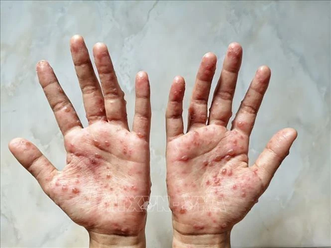 Các ban đỏ nổi trên tay 1 bệnh nhân mắc bệnh đậu mùa khỉ. (Ảnh: Shutterstock/TTXVN)