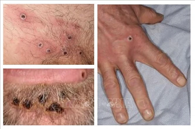 Các ban đậu mùa khỉ trên da của bệnh nhân. (Ảnh: AFP/TTXVN)