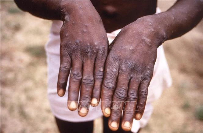 Bàn tay của bệnh nhân mắc đậu mùa khỉ. (Ảnh: AFP/TTXVN)
