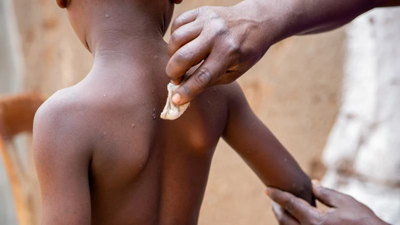 Một bệnh nhi hồi phục sau khi khỏi bệnh mpox, Bujumbura, Burundi, ngày 28/8/2024. (Ảnh: Reuters) 