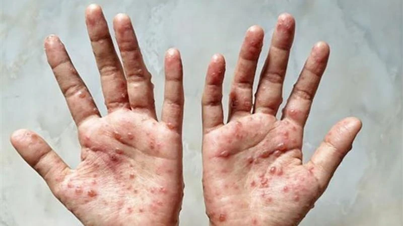 Các ban đỏ nổi trên tay một bệnh nhân mắc đậu mùa khỉ. (Ảnh: Shutterstock/TTXVN)