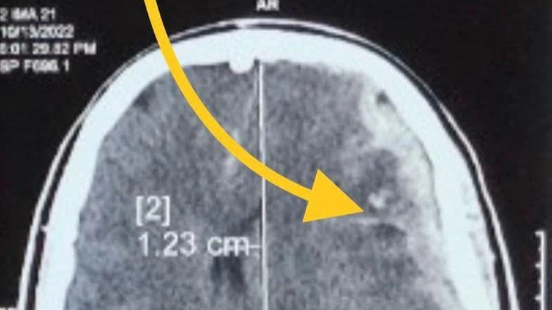Hình ảnh cho thấy bệnh nhân bị tổn thương não.