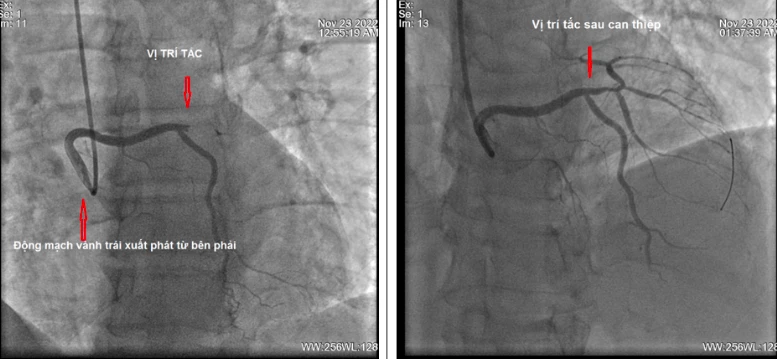 Hình ảnh chụp động mạch vành trước và sau khi can thiệp. (Ảnh: BVCC)