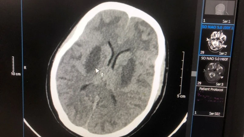 Hình ảnh tổn thương não của bệnh nhân Triệu Văn N.