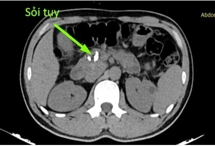 Hình ảnh sỏi tụy.