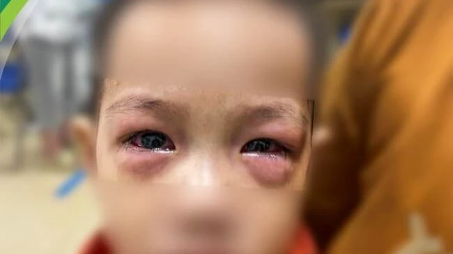 Trẻ bị viêm kết mạc điều trị tại Bệnh viện Nhi Trung ương.