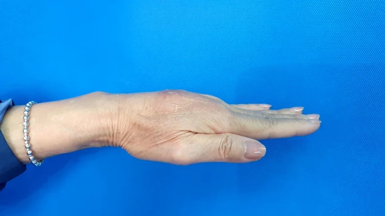 Bàn tay bị biến chứng u hạt sau khi tiêm filler tay.