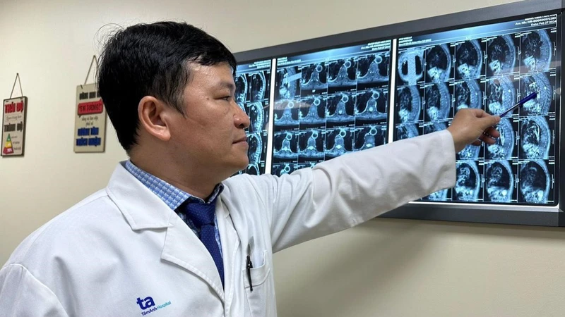 Bác sĩ Bảo Ngọc đang xem xét khối u của ông L. nằm trọn trong ống sống ngực. 