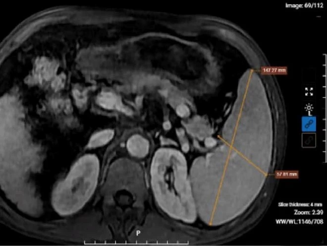 Kết quả chụp MRI của bệnh nhân nghiện rượu cho thấy hình ảnh xơ gan lách to, dịch bao quanh gan. (Ảnh: BVCC)