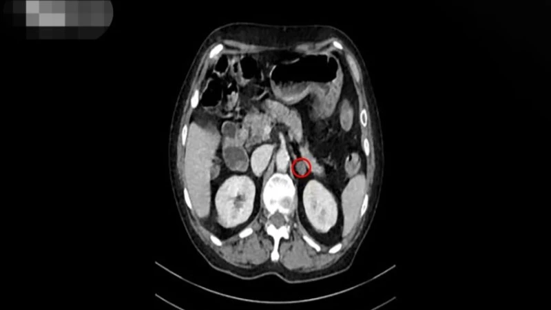 Trên phim CT scan thấy tuyến thượng thận trái (vòng tròn đỏ) của bà V. teo nhỏ, nhiều sang thương. 