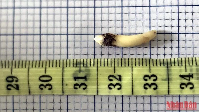 Chiếc răng dài khoảng 2cm được lấy ra khỏi hốc mũi bệnh nhân.