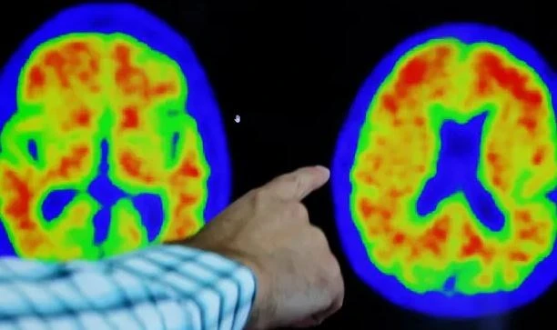Hình ảnh não của bệnh nhân Alzheimer khi chụp PET. (Nguồn: Reuters)