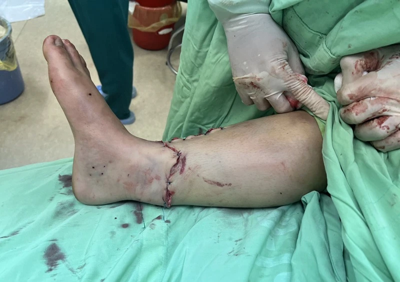 Ca phẫu thuật kéo dài 5 giờ nối thành công bàn chân bị đứt rời cho bệnh nhân P.T.P bị tai nạn giao thông.