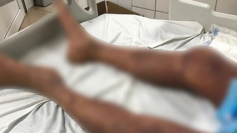 Một trường hợp toàn thân tím đen vì mắc liên cầu lợn. (Ảnh: Vietnam+)