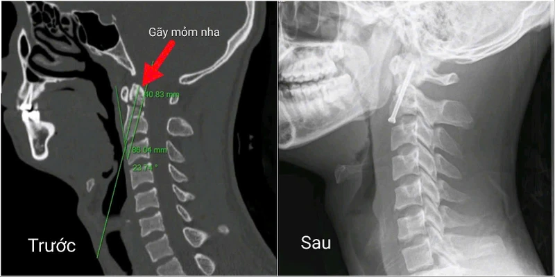 Phẫu thuật nội soi vít trực tiếp mỏm nha là một tiến bộ trong phẫu thuật cột sống cổ.