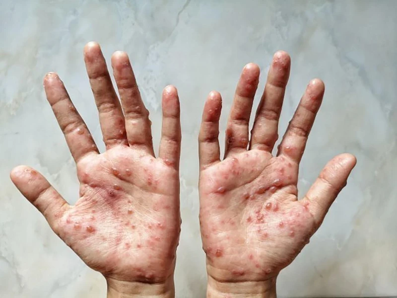 Các ban đỏ nổi trên tay 1 bệnh nhân mắc đậu mùa khỉ. (Ảnh: Shutterstock/TTXVN)
