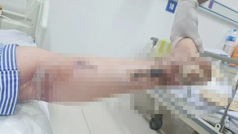 Hoại tử chân ở người bệnh đái tháo đường