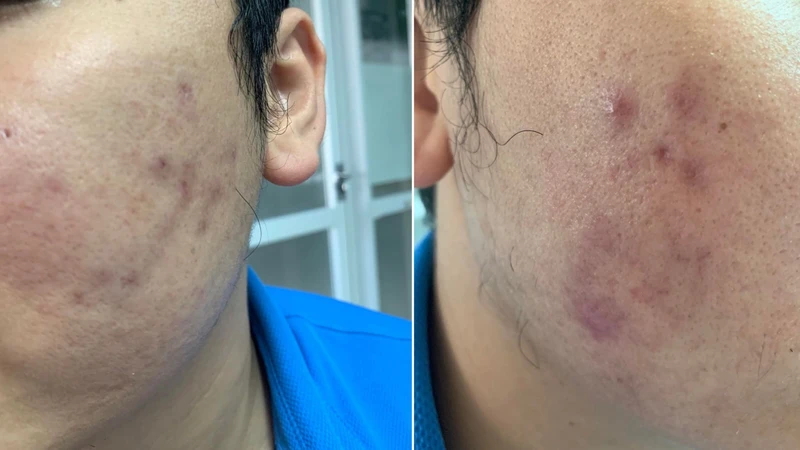 Bệnh nhân gặp biến chứng sau khi tiêm meso để làm đẹp.