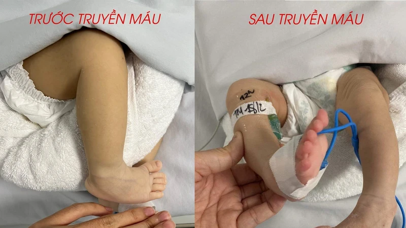 Bệnh nhi bình phục sau khi được truyền máu. 