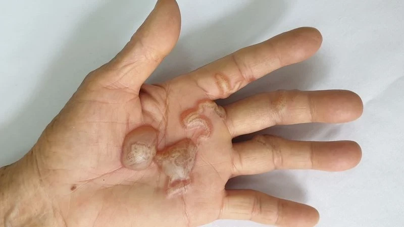 Ấu trùng giun móc chó, mèo tạo đường hầm và gây tổn thương trên da người. (Ảnh minh họa)
