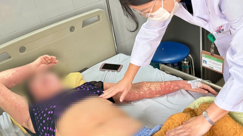 Biểu hiện dị ứng thuốc nặng của bệnh nhân.