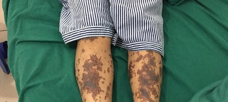 Một bệnh nhân mắc bệnh Liên câu lợn đang được điều trị tại bệnh viện. (Ảnh minh họa)